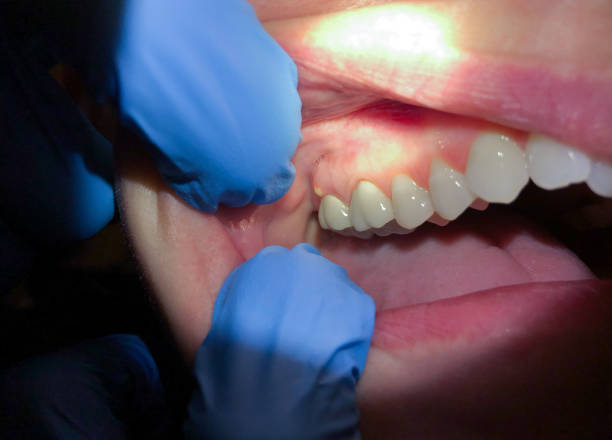 Best Emergency Wisdom Teeth Removal in Pennsboro, WV